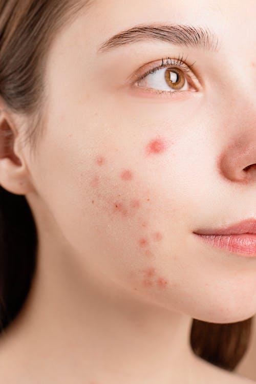 acne dieptereiniging behandeling puisten gezicht healthy skin clinic alphen aan den rijn